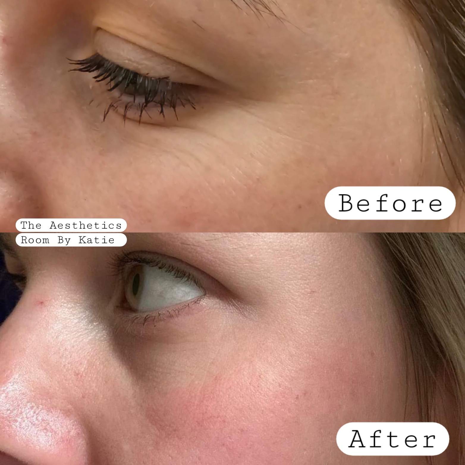 A before and after image of anti-wrinkle injections