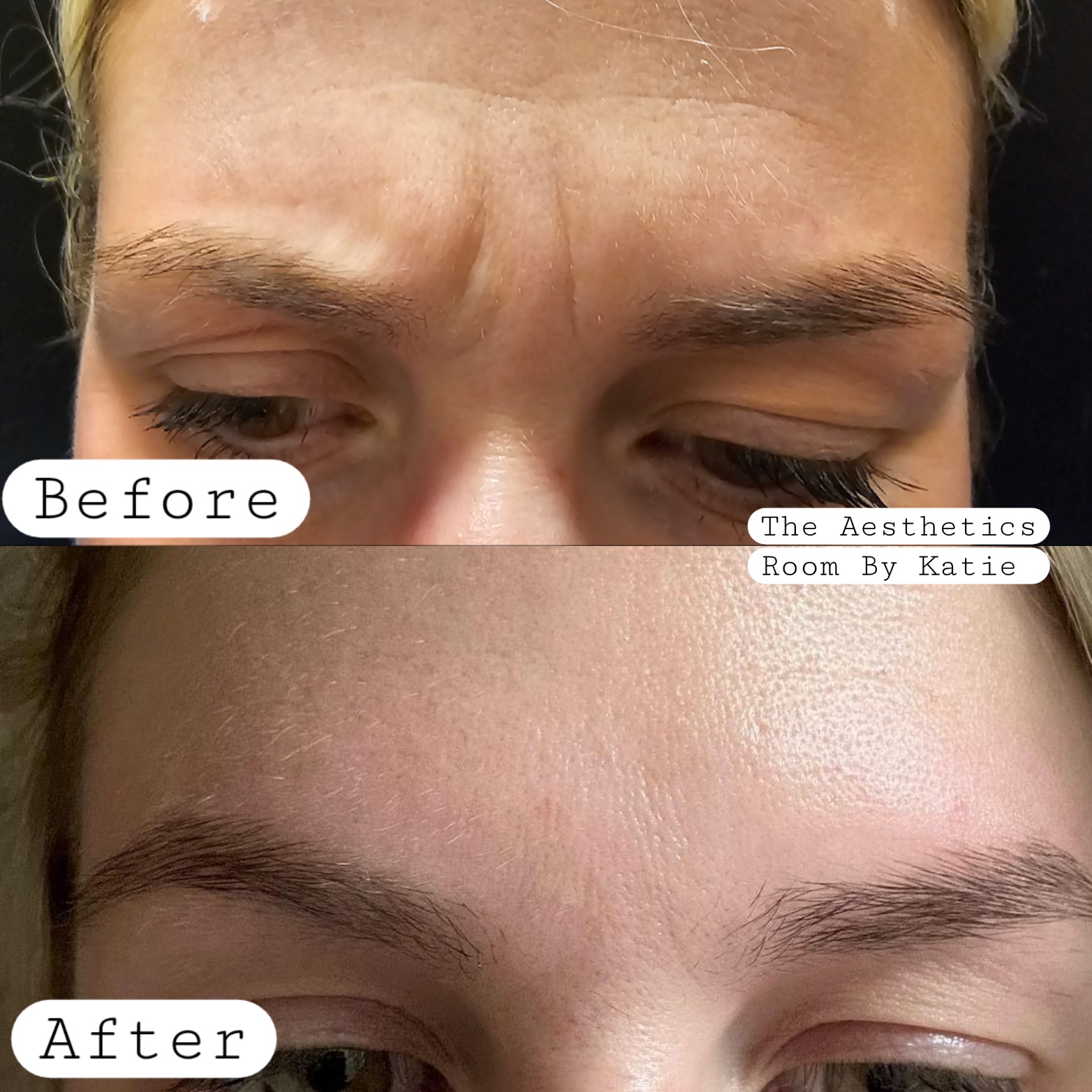 A before and after image of anti wrinkle injectons